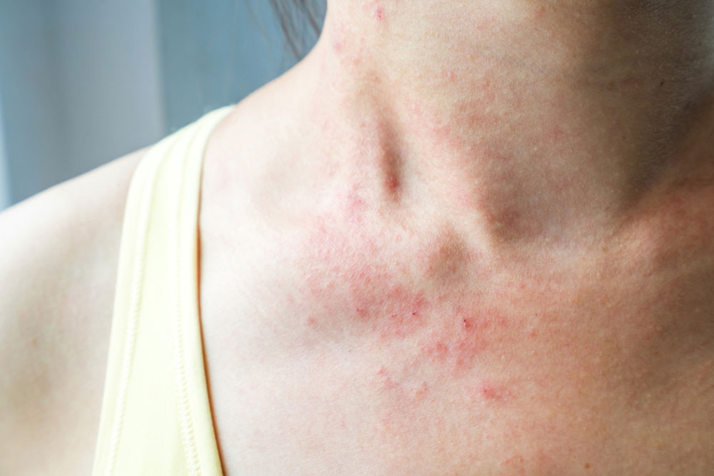 Mycosis fungoides – more than just a skin rash