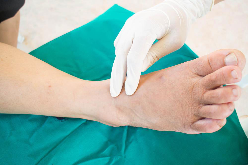 Neuropathy – An Overview