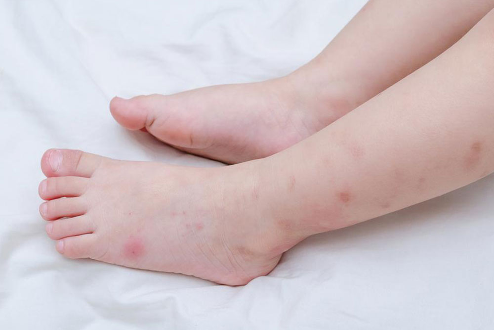 Here’s how to identify insect bites quickly