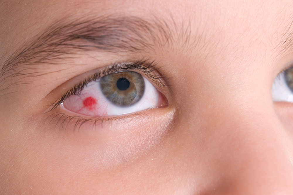Eye infections – All you need to know