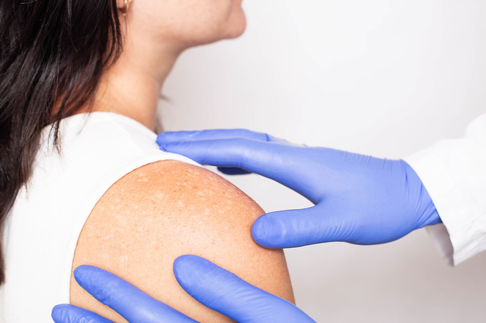 Vitiligo – Signs, Causes, and Management Remedies